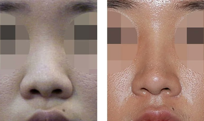  | Korea's Top Nose Revision Specialist