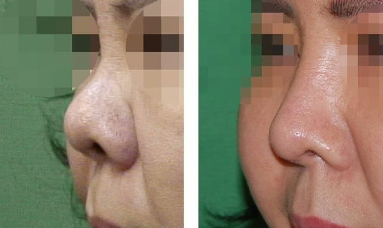  | Korea's Top Nose Revision Specialist