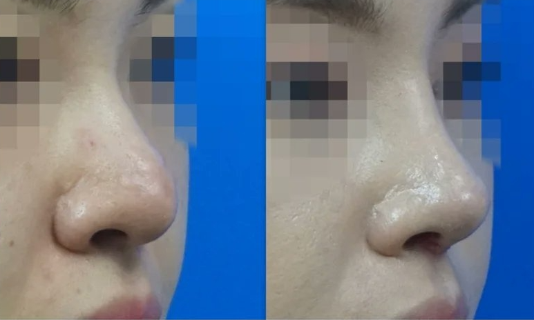  | Korea's Top Nose Revision Specialist