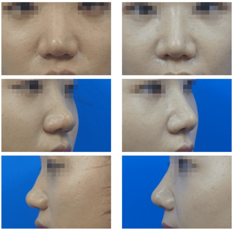  | Korea's Top Nose Revision Specialist | Korea's Top Nose Revision Specialist