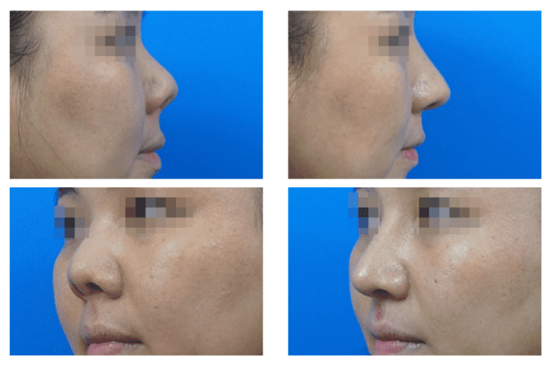  | Korea's Top Nose Revision Specialist | Korea's Top Nose Revision Specialist