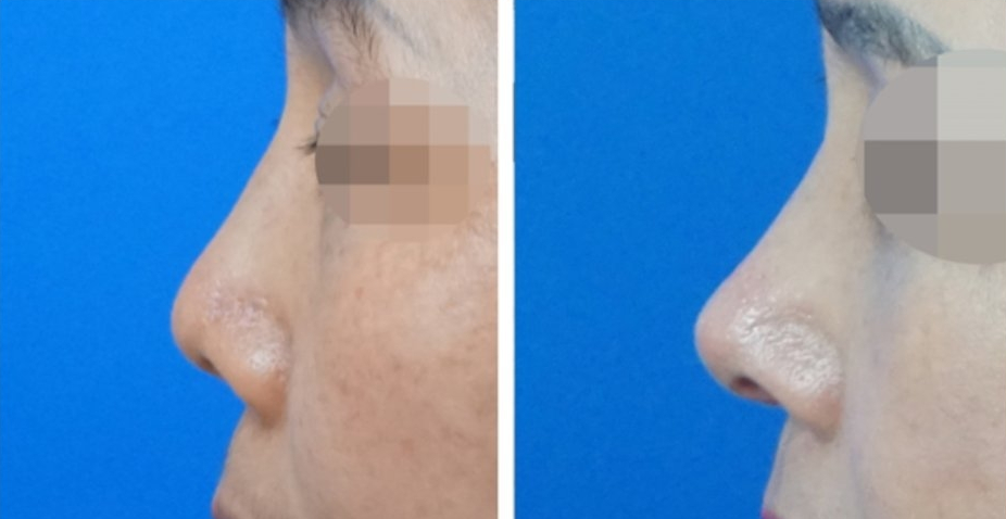  | Korea's Top Nose Revision Specialist