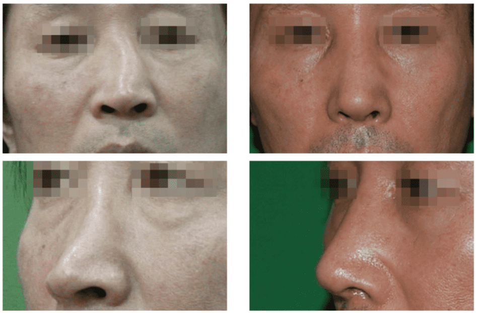  | Korea's Top Nose Revision Specialist | Korea's Top Nose Revision Specialist