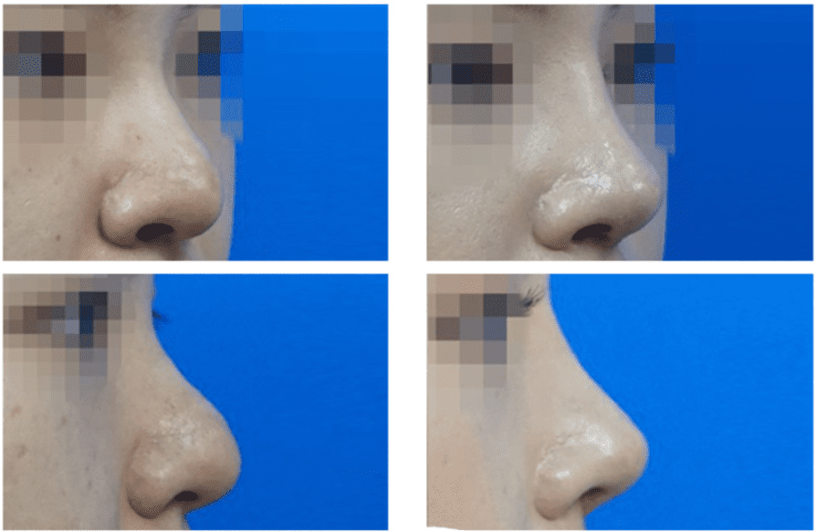  | Korea's Top Nose Revision Specialist | Korea's Top Nose Revision Specialist