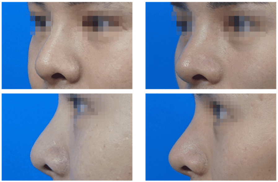  | Korea's Top Nose Revision Specialist | Korea's Top Nose Revision Specialist