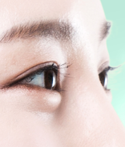  | Korea's Top Nose Revision Specialist | Korea's Top Nose Revision Specialist