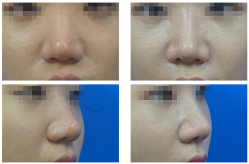  | Korea's Top Nose Revision Specialist