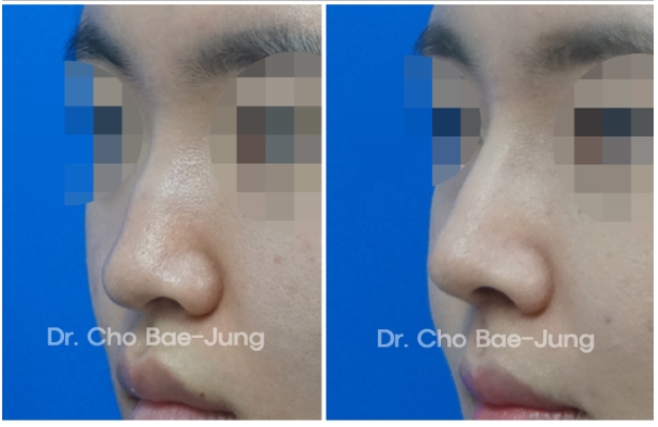  | Korea's Top Nose Revision Specialist