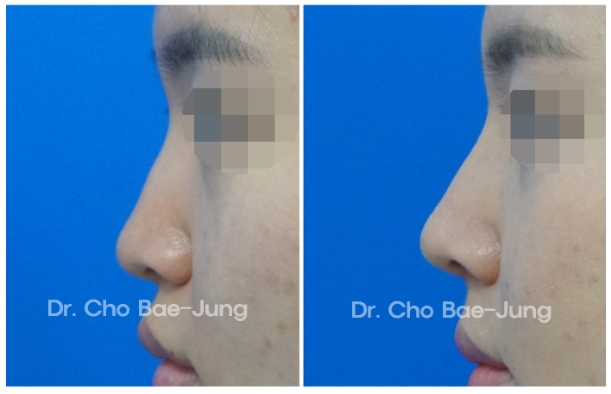  | Korea's Top Nose Revision Specialist