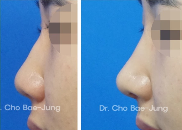  | Korea's Top Nose Revision Specialist