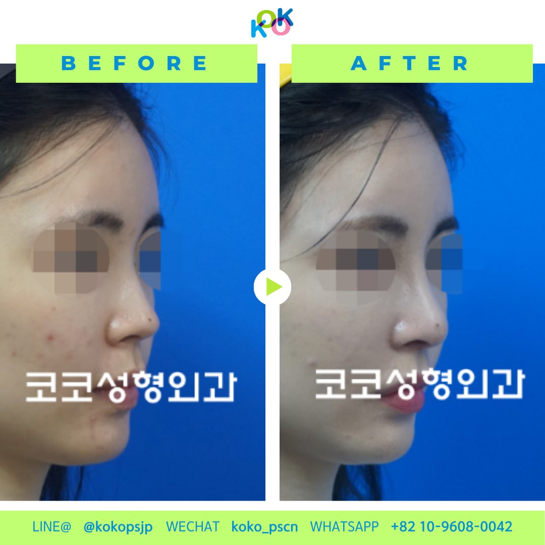  | Korea's Top Nose Revision Specialist