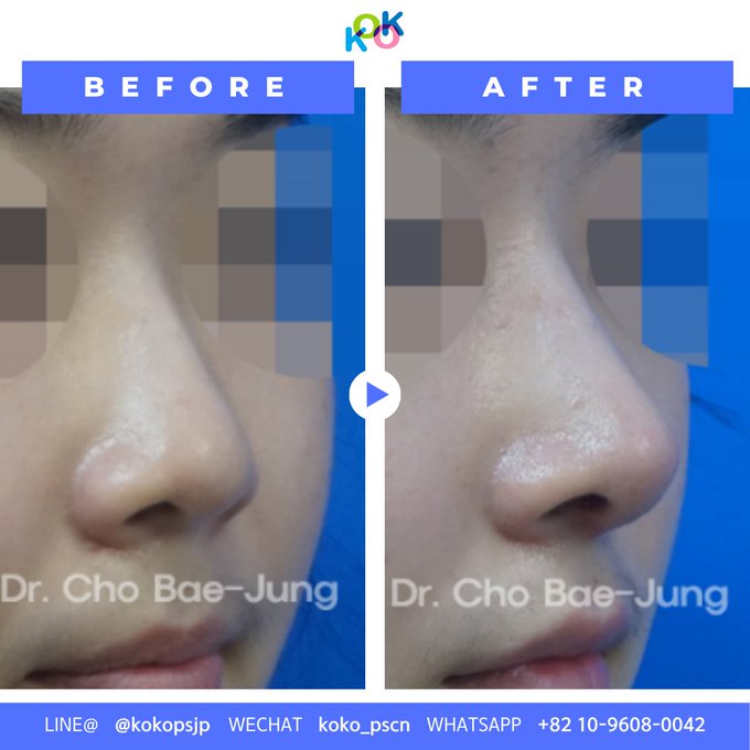  | Korea's Top Nose Revision Specialist