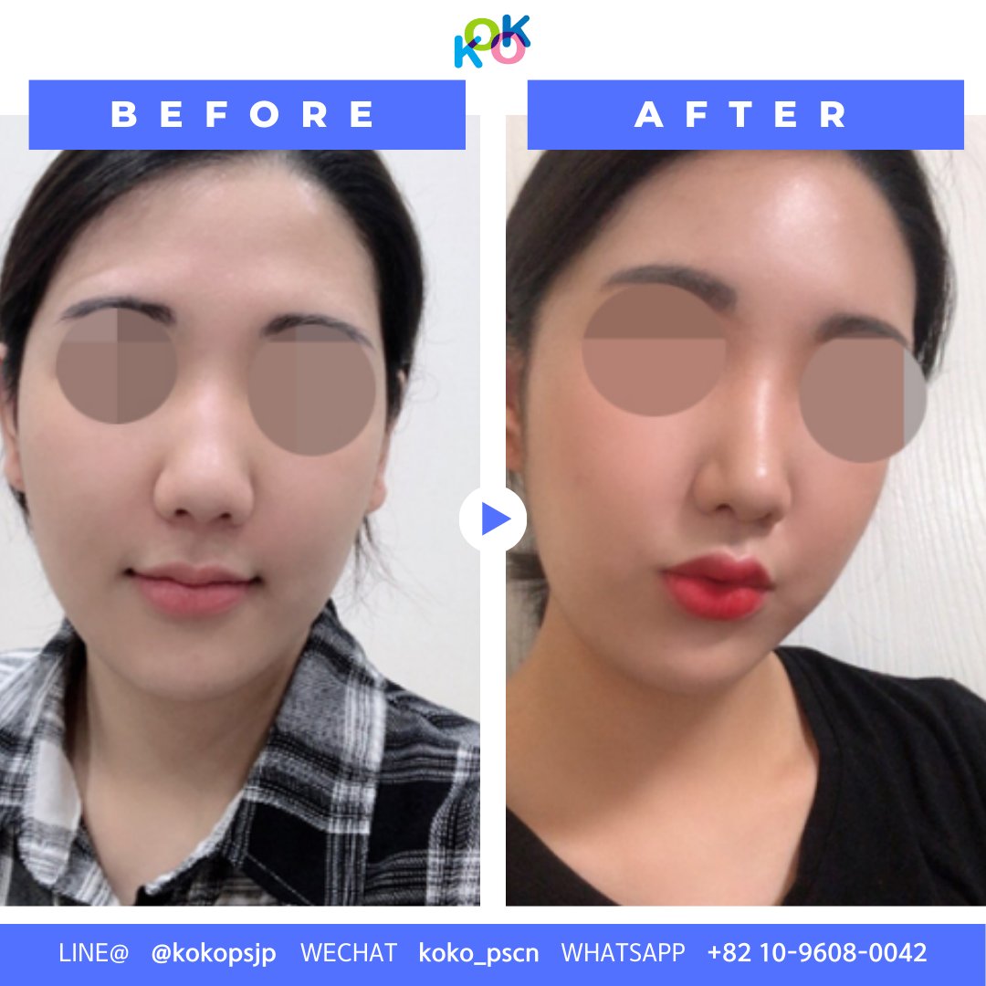  | Korea's Top Nose Revision Specialist