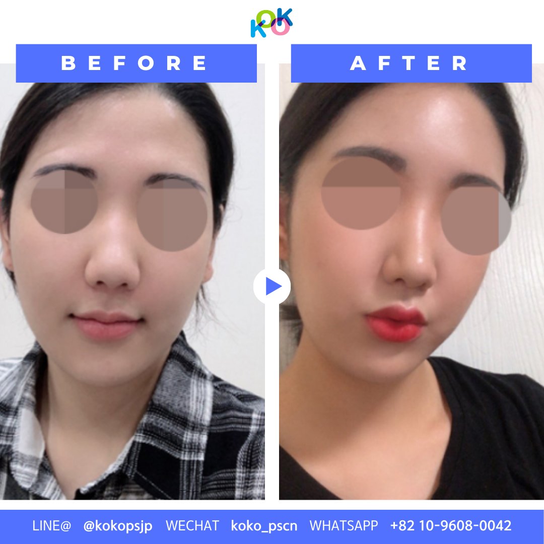 「鼻整形の症例紹介｜KOKO美容外科：ココで理想の鼻を手に入れましょう」 このテキストには、「鼻整形」「ココ美容外科」のキーワードを含め、内容に合った説明が含まれています。 | Korea's Top Nose Revision Specialist