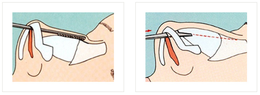  | Korea's Top Nose Revision Specialist