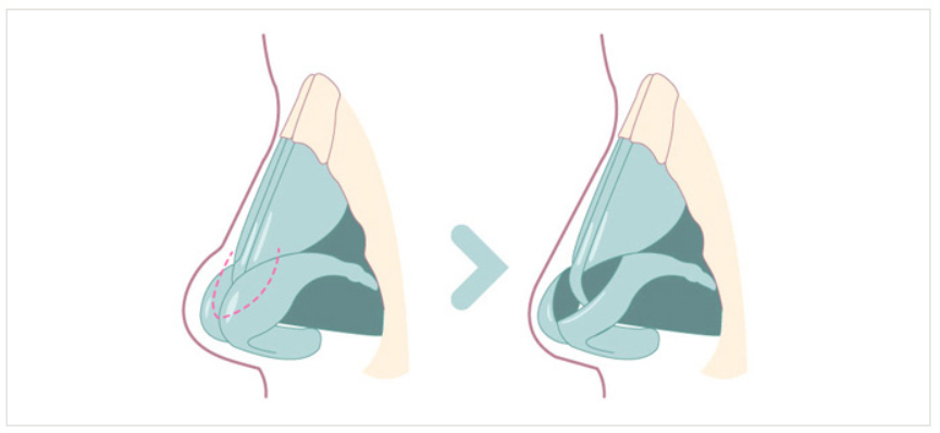 Cartilage resection surgery | Korea's Top Nose Revision Specialist