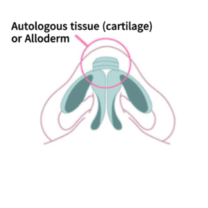 Augmentation rhinoplasty | Korea's Top Nose Revision Specialist