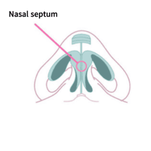 Tip rhinoplasty utilizing nasal dorsal augmentation with grafting | Korea's Top Nose Revision Specialist