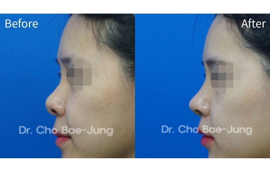 | Korea's Top Nose Revision Specialist
