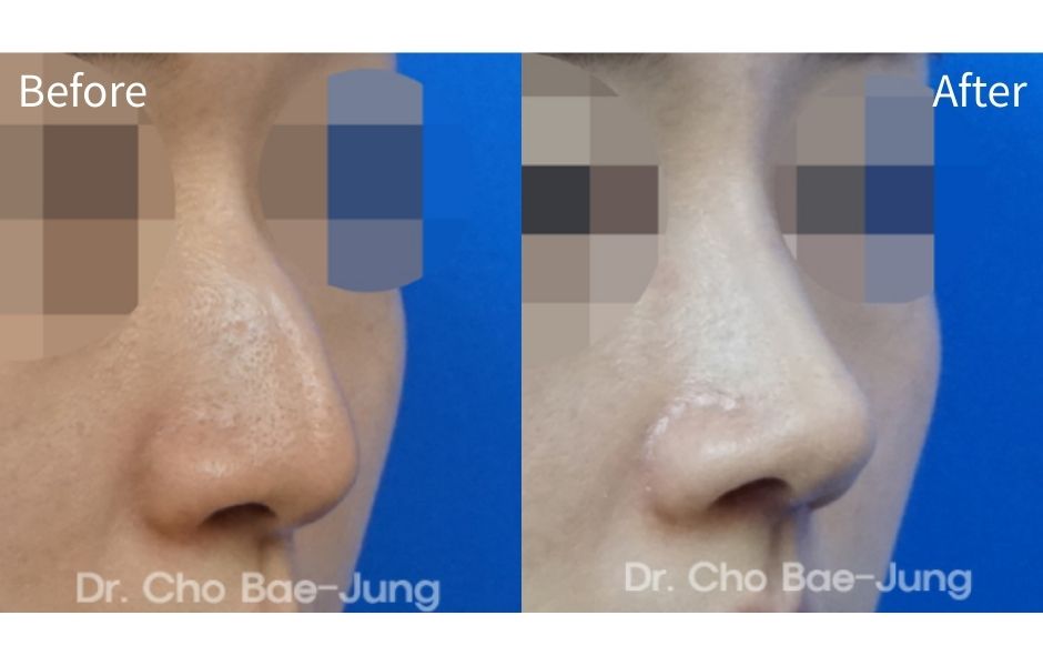  | Korea's Top Nose Revision Specialist