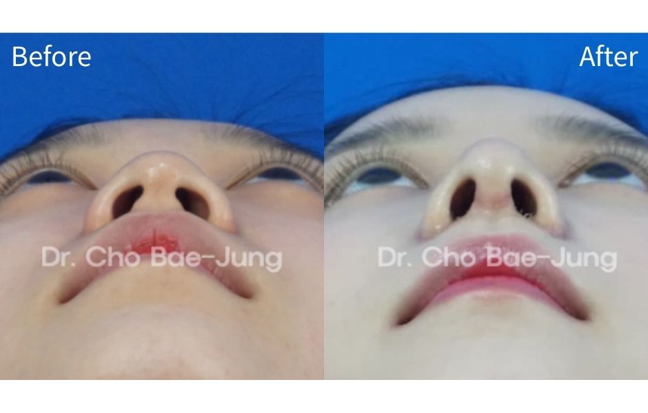  | Korea's Top Nose Revision Specialist