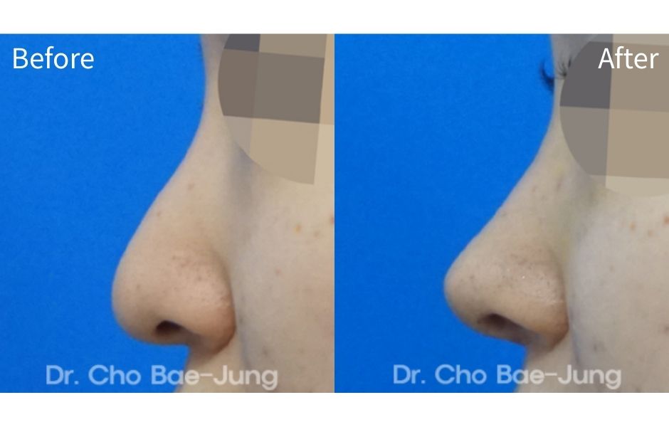  | Korea's Top Nose Revision Specialist