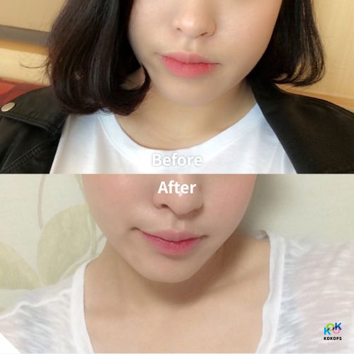 A before-and-after photo of a black-haired woman with a bob haircut achieving a perfect V-line with a face slimming injection in Korea, enhancing her already slim facial contour.