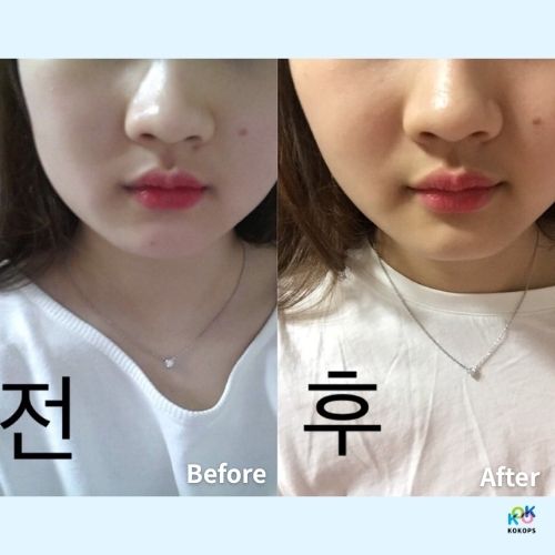 A before and after photo showcasing a woman's face transformation from round to a slimmer V-line after a face slimming injection in Seoul