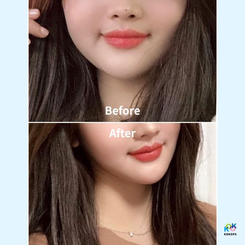 A before and after photo showcasing a woman's half-face transformation with a V-line fat dissolving injection at a Seoul clinic.