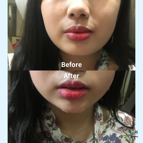A before and after photo showcasing a woman's face transformation from round to a slimmer V-line after a face slimming injection in Seoul