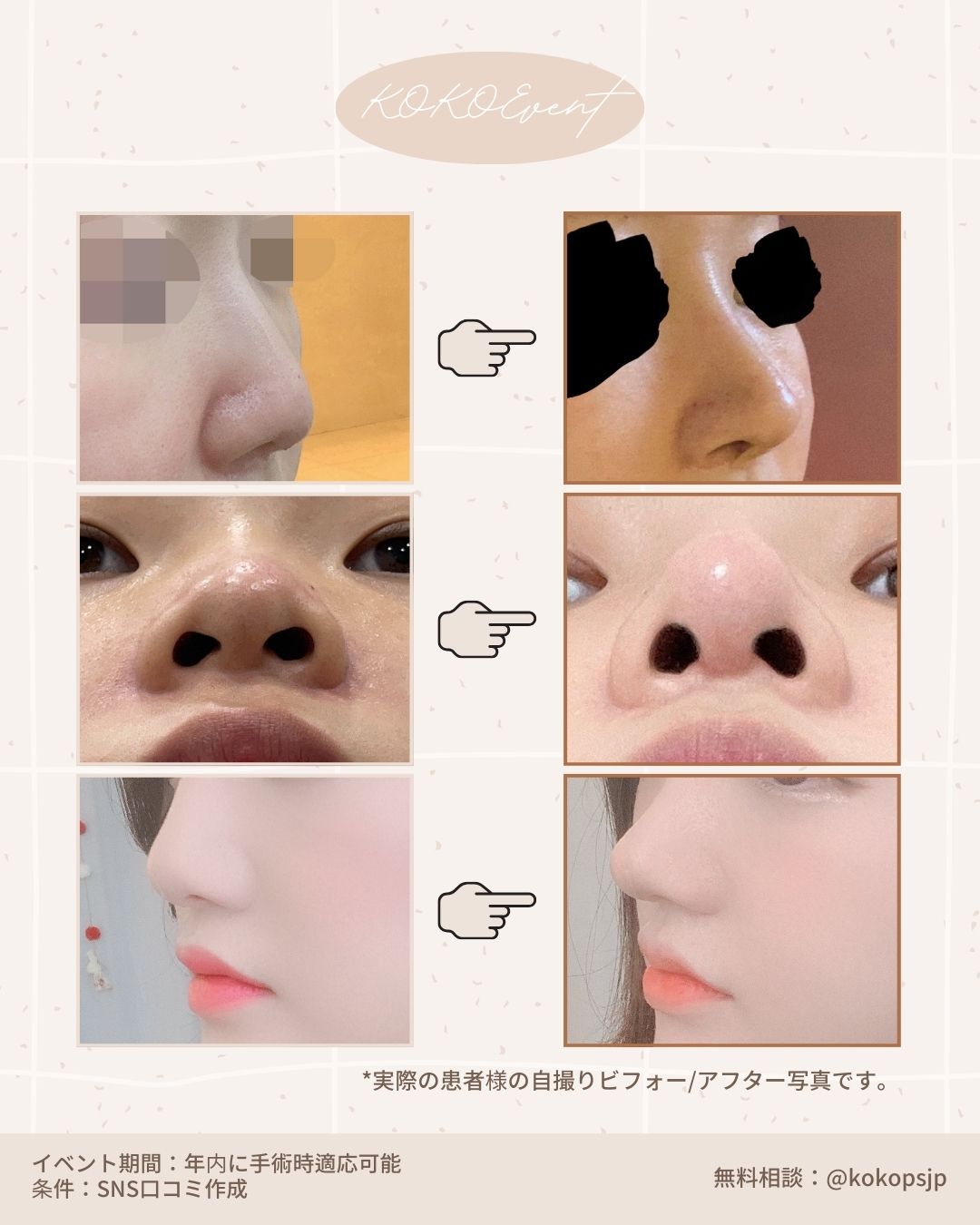 ココ美容外科+初めての鼻手術+イベント+鼻整形+韓国鼻整形+韓国美容外科+鼻整形専門医 3 | Korea's Top Nose Revision Specialist KOKO美容外科の韓国鼻整形ビフォーアフター症例写真。実際の患者による自撮りで、鼻筋のライン、小鼻の形状、横顔のEラインの変化が比較されている。イベント条件は年内手術とSNS口コミ作成。無料相談LINEは @kokopsjp 。