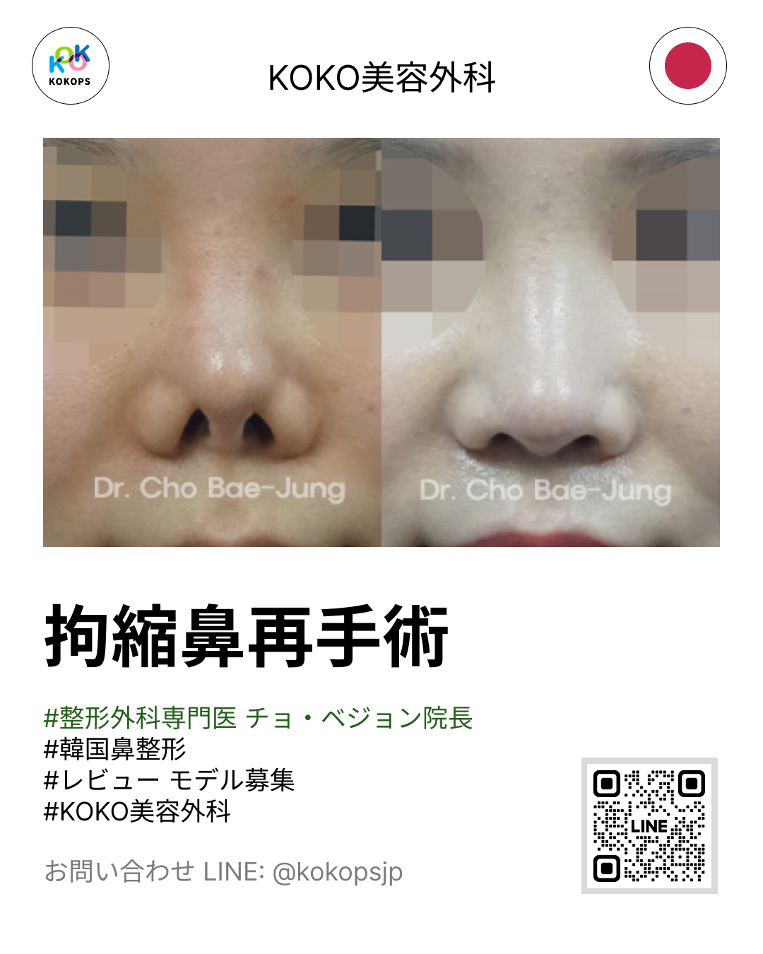 KOKO美容外科のチョ・ベジョン院長による拘縮鼻再手術（こうしゅくばな）の症例写真。手術前後の変化を確認できるビフォーアフター画像です。整形外科専門医が執刀する信頼できる韓国鼻整形。お問い合わせは画像のLINE QRコードまたはID（@kokopsjp）から可能です。