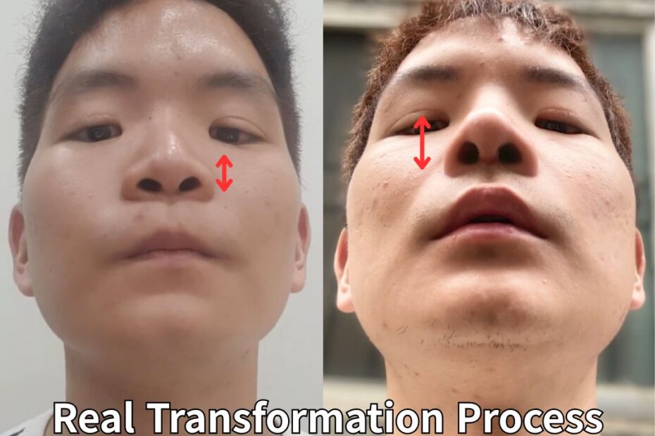 A before-and-after comparison of a man’s rhinoplasty. The left image shows a lower, shorter nose, while the right image shows a more defined and lengthened bridge. The text reads "Men’s Rhinoplasty Review: Real Transformation Proc