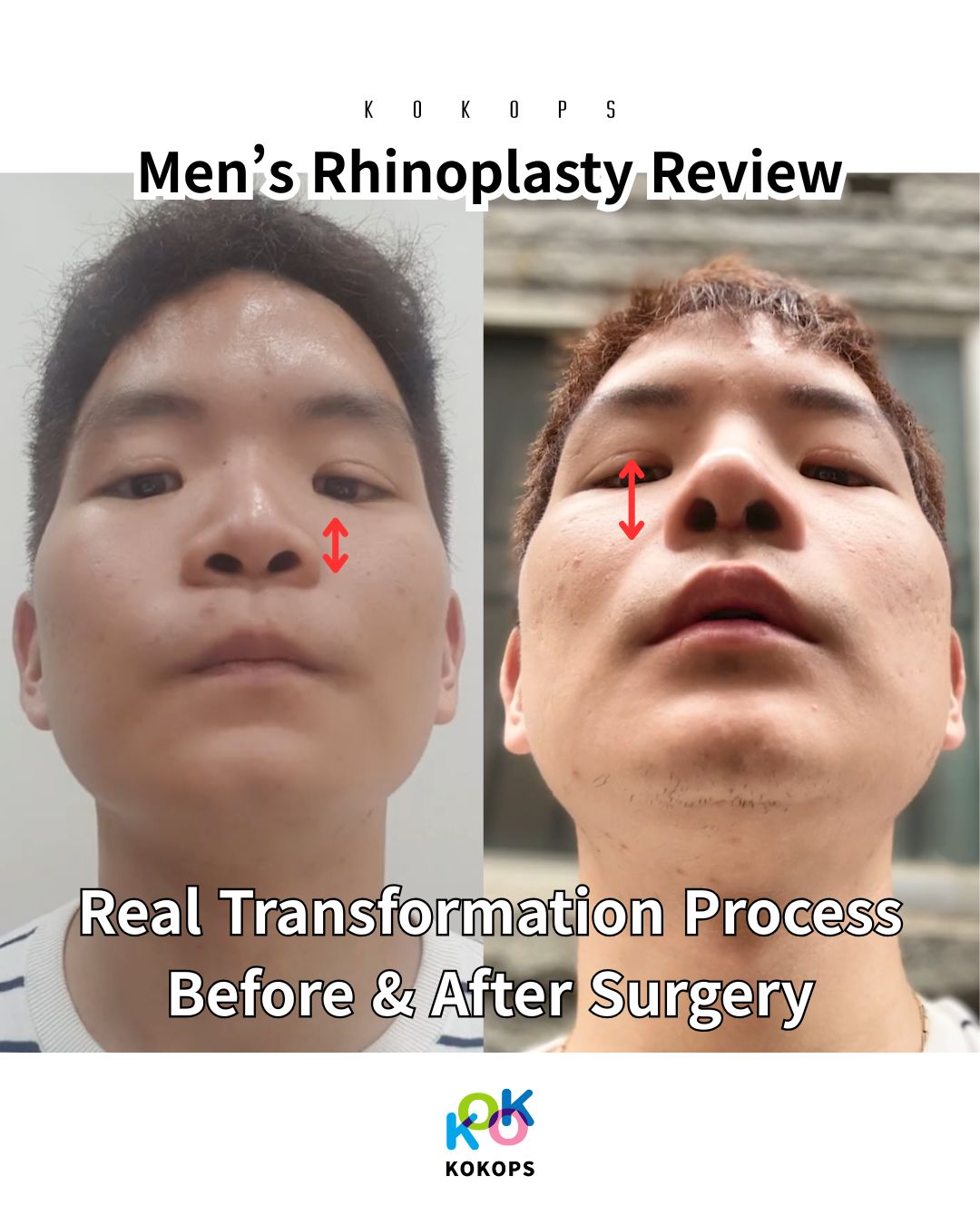 A before-and-after comparison of a man’s rhinoplasty. The left image shows a lower, shorter nose, while the right image shows a more defined and lengthened bridge. The text reads "Men’s Rhinoplasty Review: Real Transformation Proc | Korea's Top Nose Revision Specialist