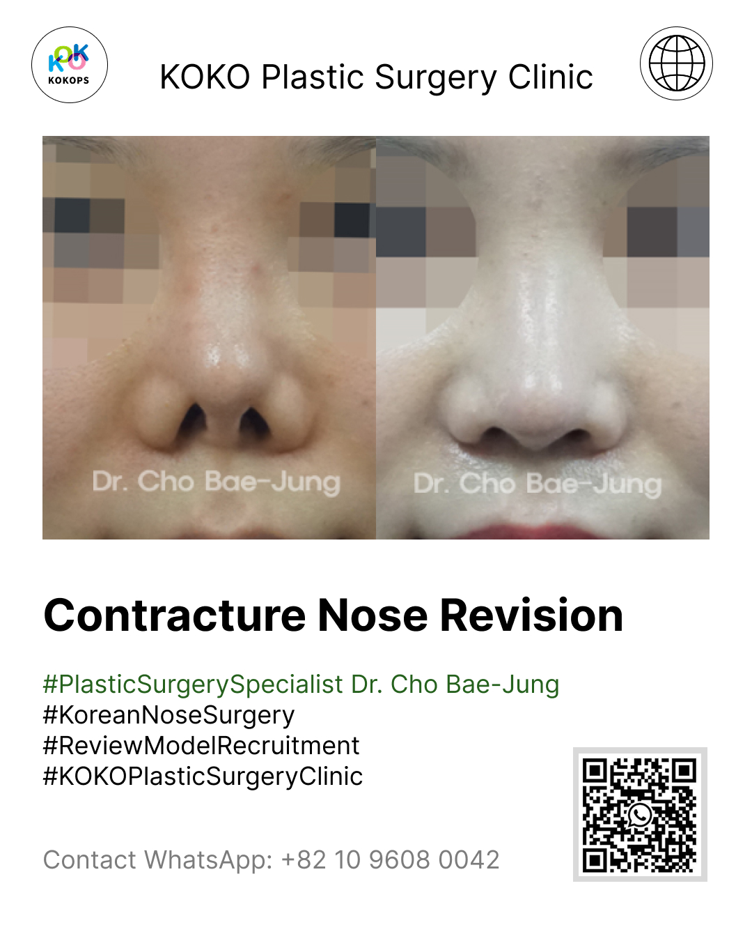 Before and after case of Contracture Nose Revision performed by plastic surgery specialist Dr. Cho Bae-Jung at KOKO Plastic Surgery Clinic. The side-by-side comparison shows the correction of a contracted, upturned nose for a natural result. Includes a WhatsApp QR code and contact number (+82 10 9608 0042) for consultations regarding Korean nose surgery. Nose Revision Surgery