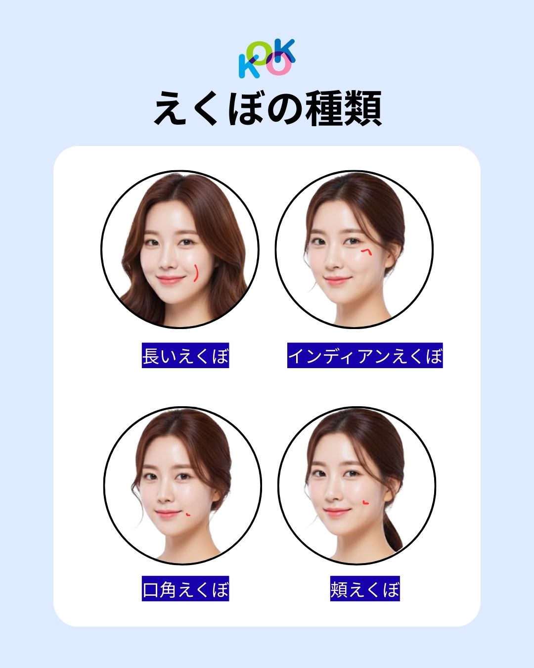 えくぼの種類+長いえくぼ+インディアンえくぼ+口角えくぼ+頬えくぼ 2 | Korea's Top Nose Revision Specialist えくぼの種類4つのタイプ別に紹介する比較画像。韓国式の自然な仕上がりをイメージしたイラストで、「長いえくぼ」「インディアンえくぼ」「口角えくぼ」「頬えくぼ」のそれぞれの位置が赤い線で分かりやすく示されています。