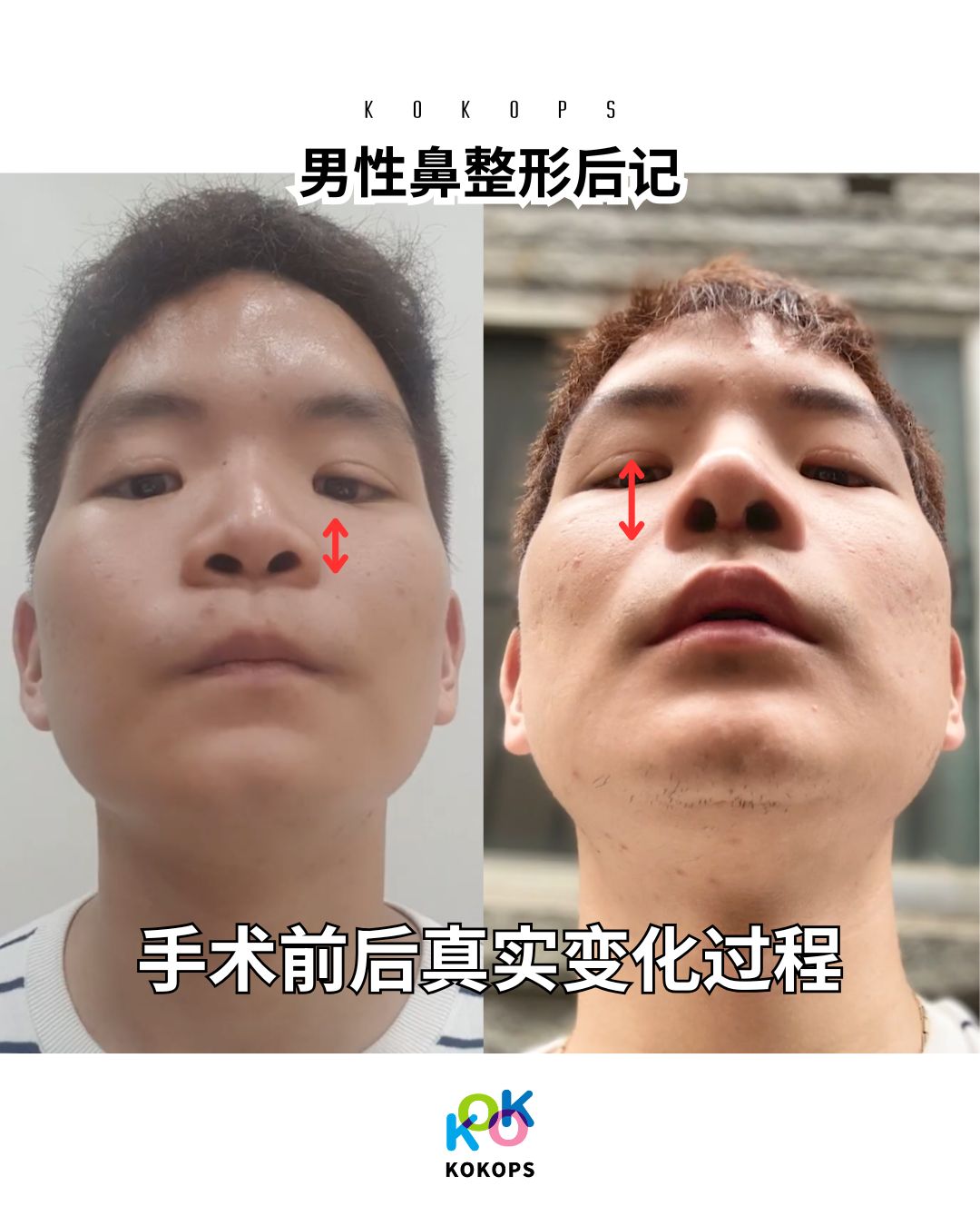 鼻整形名医亲自操刀的男性隆鼻手术前后对比图｜改善低鼻梁与朝天鼻的真实变化过程（KOKO整形外科）