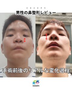 鼻整形名医による男性の鼻整形ビフォーアフター写真｜低い鼻・アップノーズを自然に改善したリアルな変化過程（KOKO美容外科）