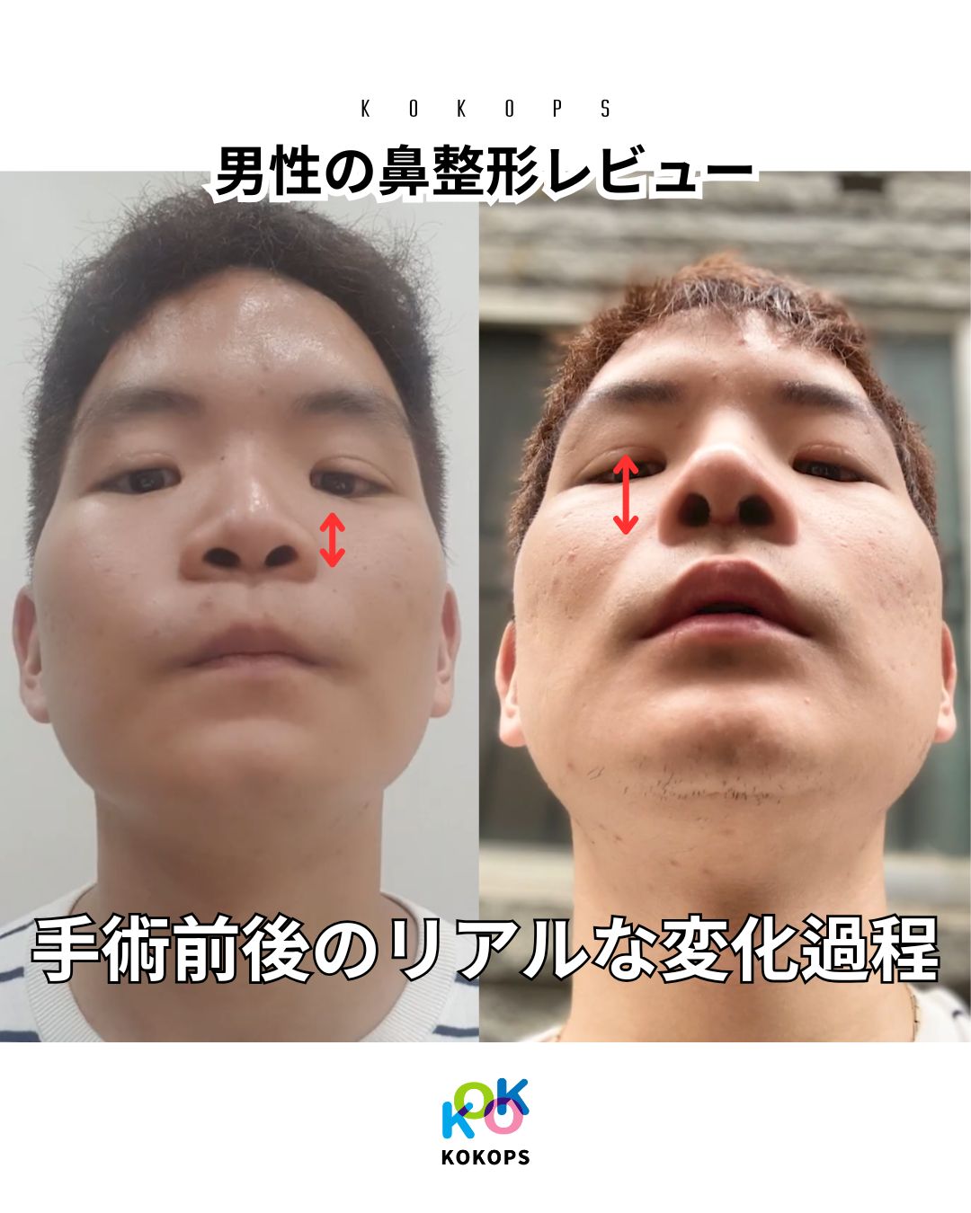 鼻整形名医による男性の鼻整形ビフォーアフター写真｜低い鼻・アップノーズを自然に改善したリアルな変化過程（KOKO美容外科）