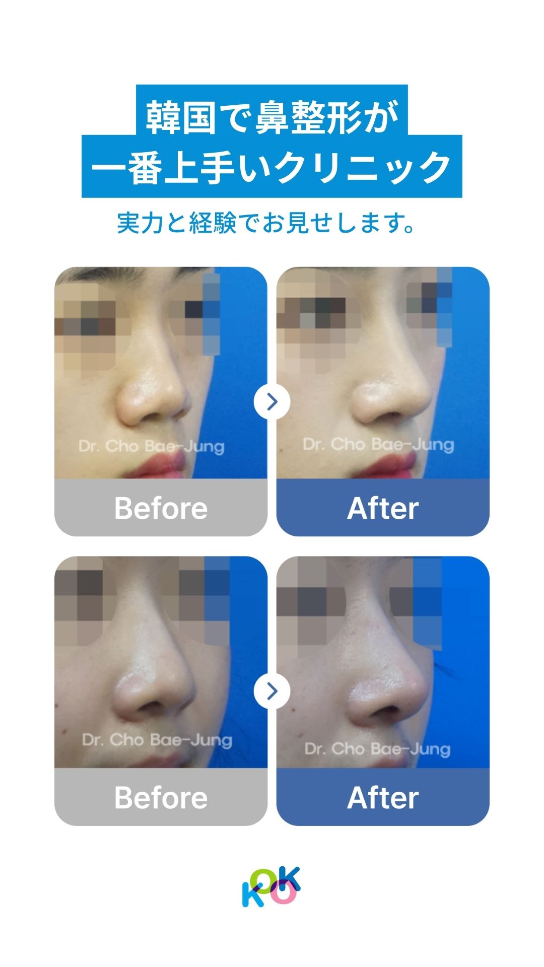 鼻整形の症例写真（Before & After）。「韓国で鼻整形が一番上手いクリニック。実力と経験でお見せします」という見出しのもと、2名の患者の鼻のビフォーアフターが並んでいる。術後は鼻筋が通り、鼻先が整った様子が示されている。各写真には「Dr. Cho Bae-Jung」のロゴが入っている。