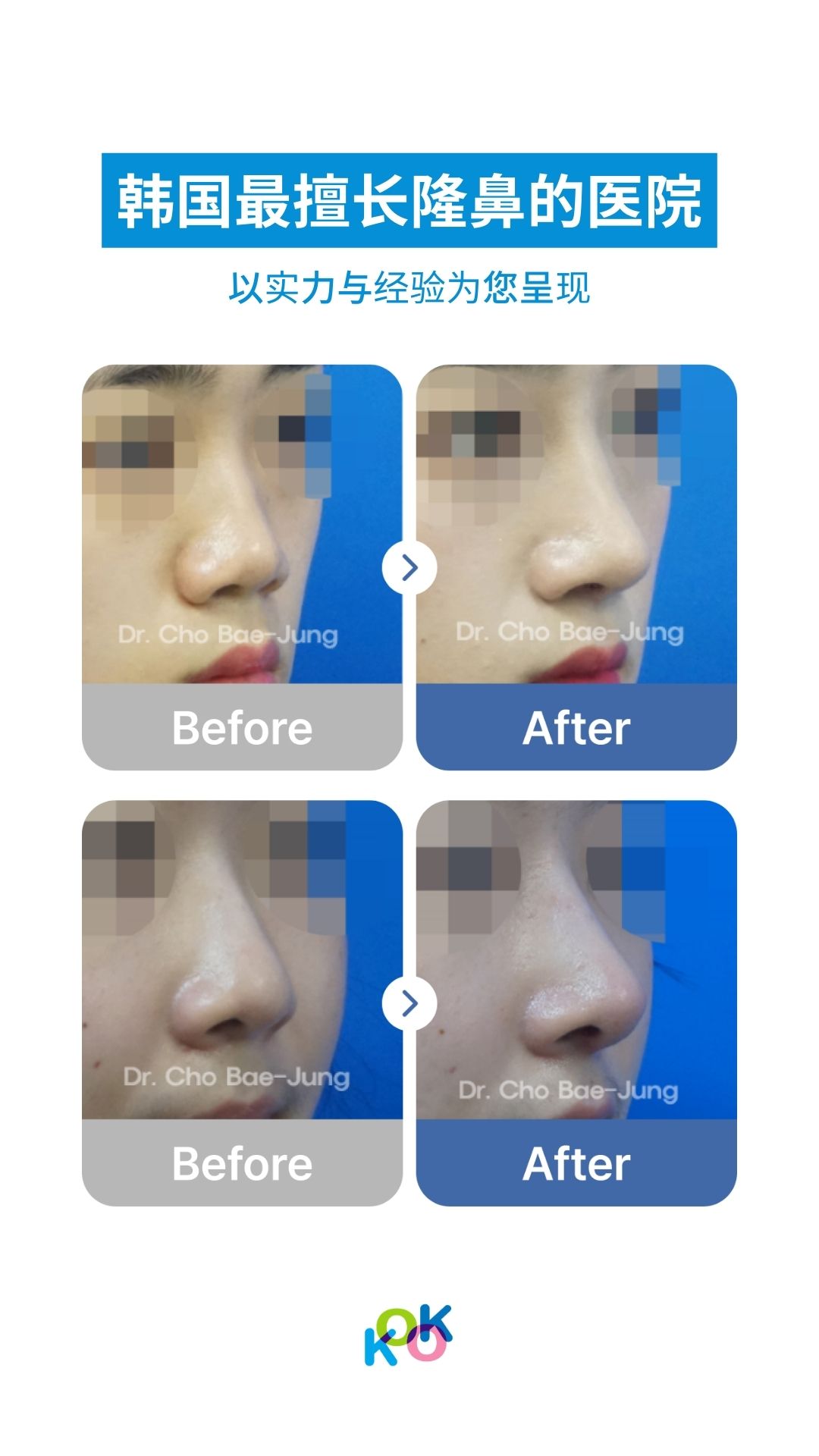 标题为“韩国最擅长隆鼻的医院”的对比图。图片展示了两组鼻部整形的术前（Before）与术后（After）侧面效果，展示了术后更加挺拔、自然的鼻梁与鼻尖。每张照片都标有“Dr. Cho Bae-Jung”的字样，底部带有KOK美容外科的标志。
