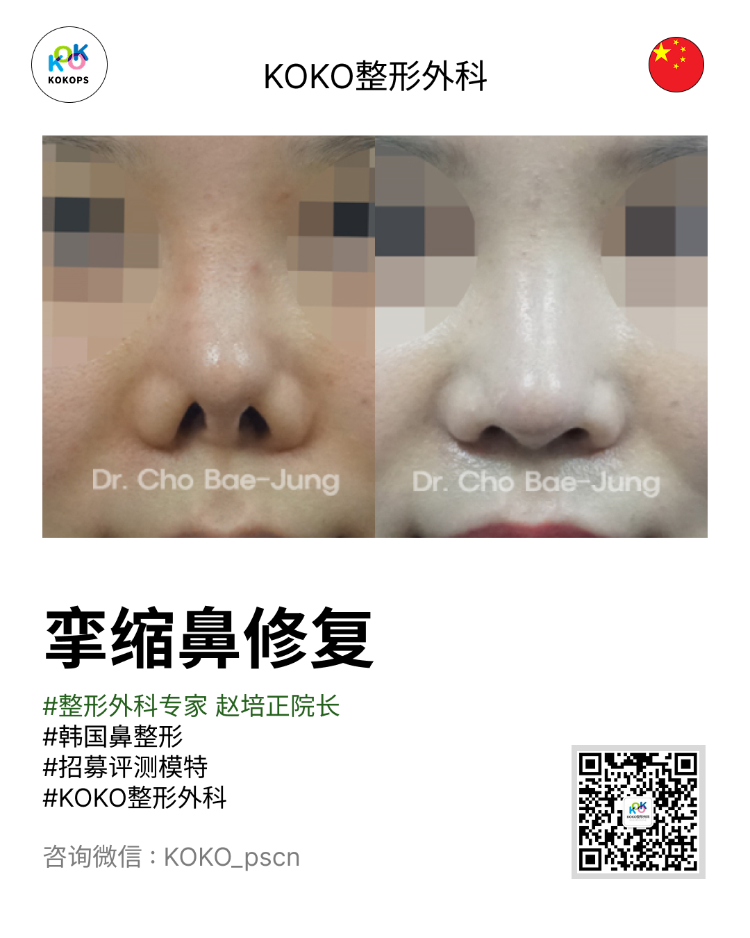 韩国鼻整形+鼻整形名医+挛缩鼻+鼻修复 3 | Korea's Top Nose Revision Specialist KO整形外科赵培正院长(Dr. Cho Bae-Jung)执刀的挛缩鼻修复手术前后对比照片(Before & After)。左侧为术前挛缩鼻形态,右侧为术后修复形态,展示了鼻孔和鼻尖的改善效果。图片包含“挛缩鼻修复”大字标题、热门标签及咨询二维码。