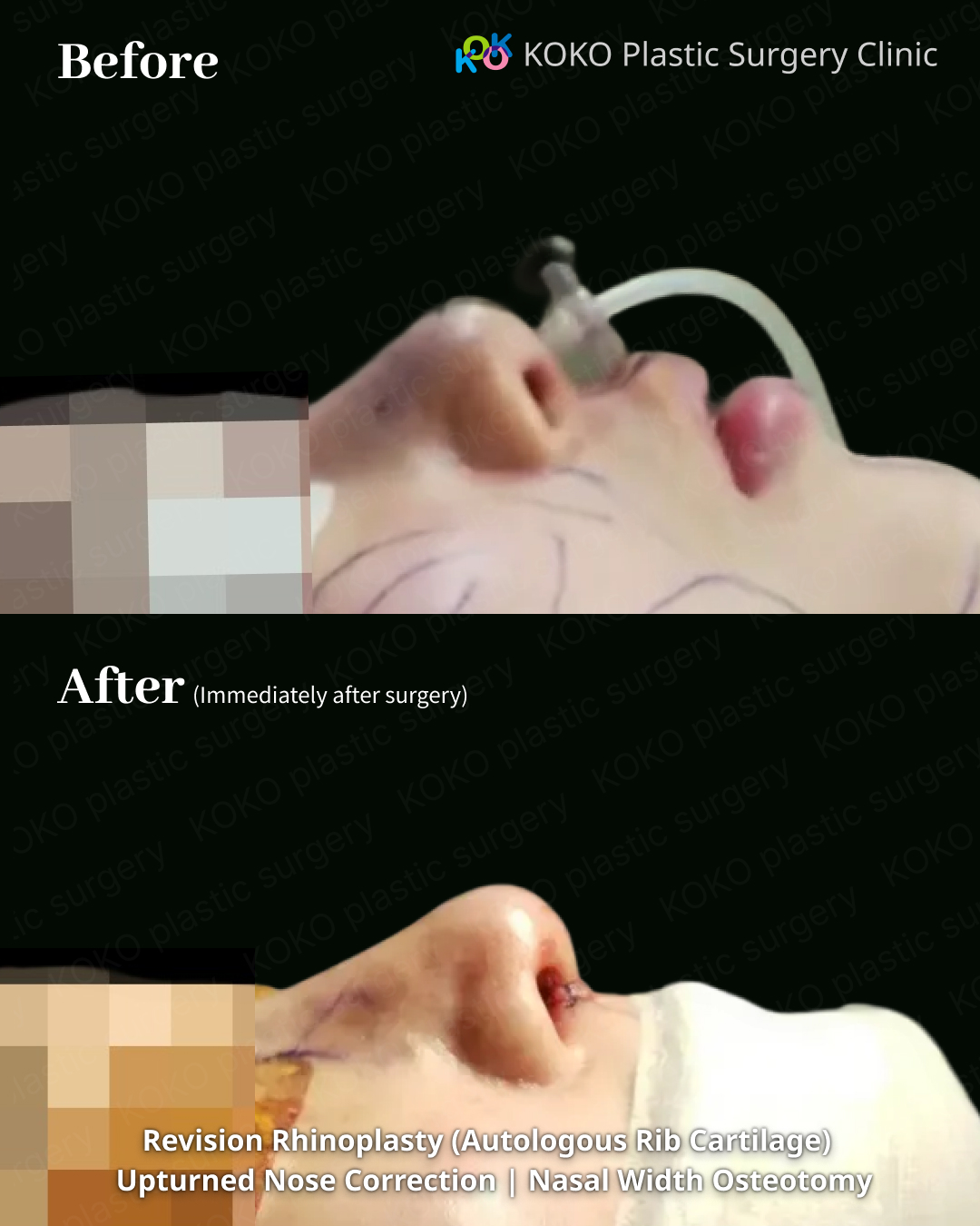 A side profile comparison of a patient before and immediately after revision rhinoplasty using autologous rib cartilage. The "Before" image shows an upturned nose with a retracted tip. The "After" image, taken on the operating table, shows a corrected nasal bridge and a significantly lengthened, downward-pointing tip, creating a more balanced and natural profile.