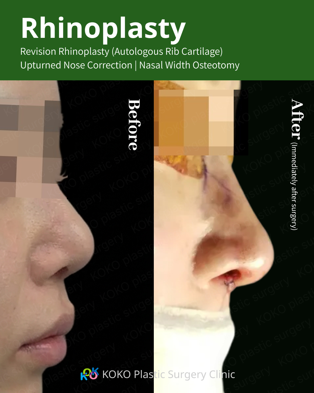 A close-up comparison focusing on the nasal tip and nostrils from a low angle. The "Before" shot shows wide nostrils and a short tip. The "After" shot, taken immediately after surgery, shows the results of using autologous rib cartilage to extend the tip and nasal width osteotomy to narrow the base, resulting in more symmetrical, vertically oriented nostrils and a projected tip.