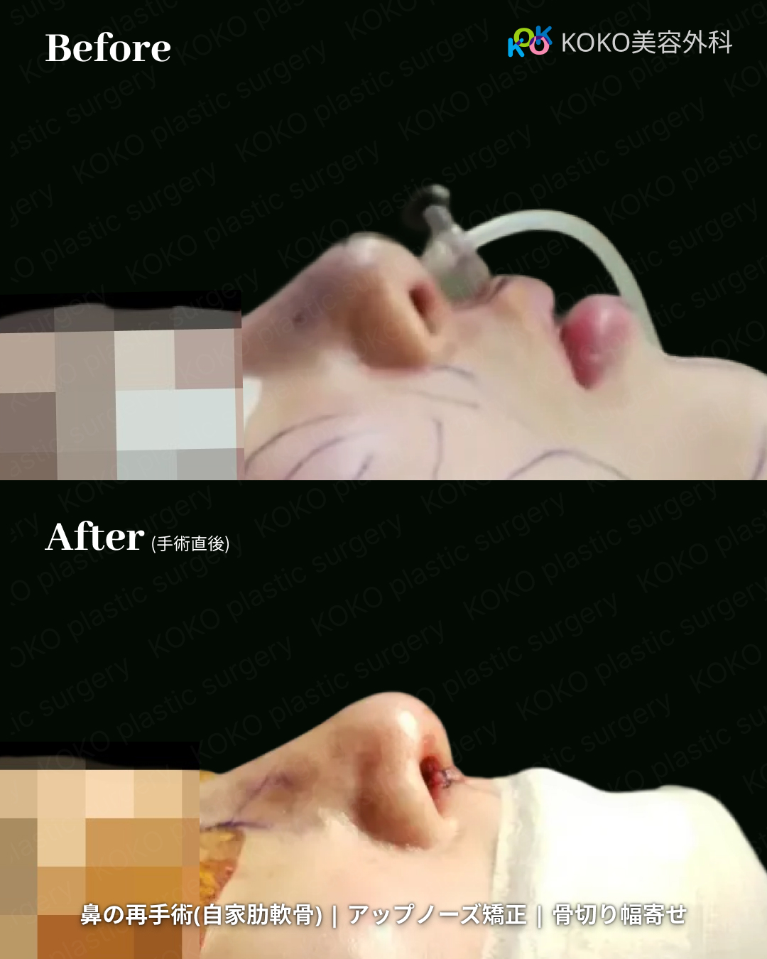 鼻の再手術（自家肋軟骨使用）、アップノーズ矯正、骨切り幅寄せの症例写真。手術前と手術直後の横顔の比較。術前は鼻先が上を向き、鼻筋のラインが不明瞭だが、術後は自家肋軟骨によって鼻先が適切な高さに延長され、滑らかな鼻筋のラインが形成されている。