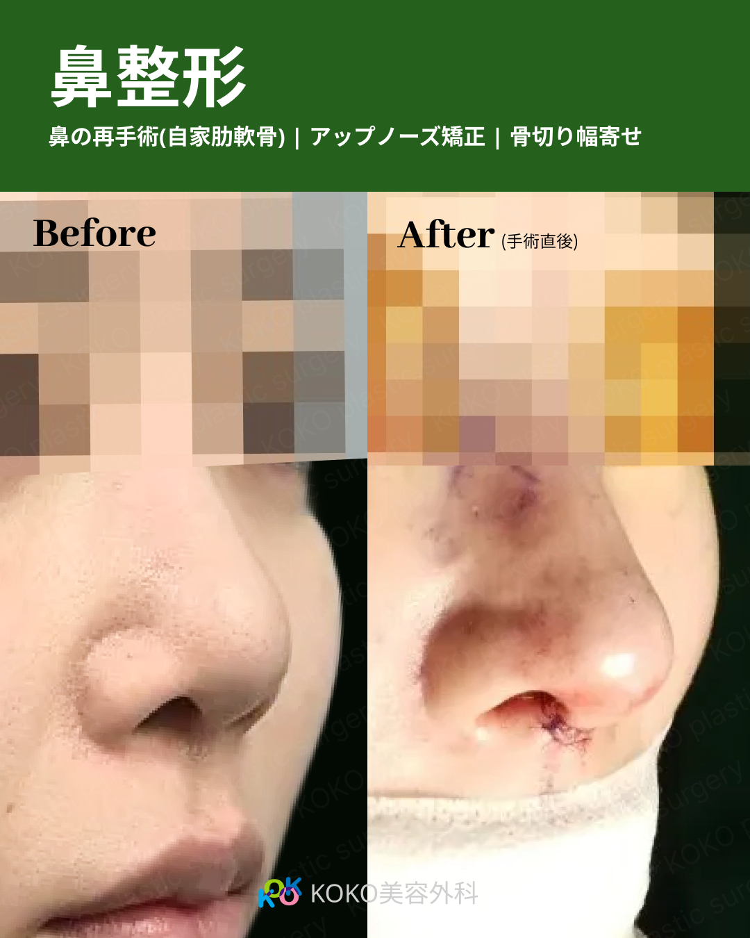 鼻の再手術の術前術後比較画像。斜め下からのアングルで、鼻先の高さと鼻孔（鼻の穴）の形に焦点を当てている。術前と比較して、術後は鼻先が前方にしっかりと出され、鼻孔の形が縦長の楕円形に整っている。自家肋軟骨を用いた鼻先形成とアップノーズ矯正の効果を示している。