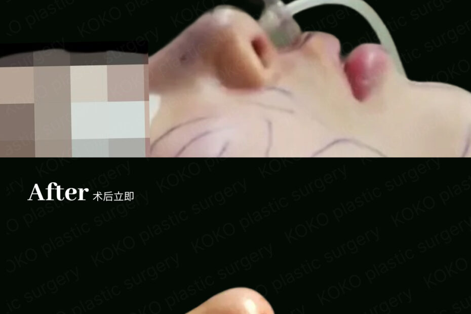 鼻修复手术对比图。上方“Before”照片显示患者躺在手术台上，鼻尖短缩且鼻孔上翻（朝天鼻）。下方“After”照片为术后立即拍摄，显示通过自体肋软骨修复后，鼻梁延长，鼻尖挺拔且下移，改善了鼻孔外露问题。
