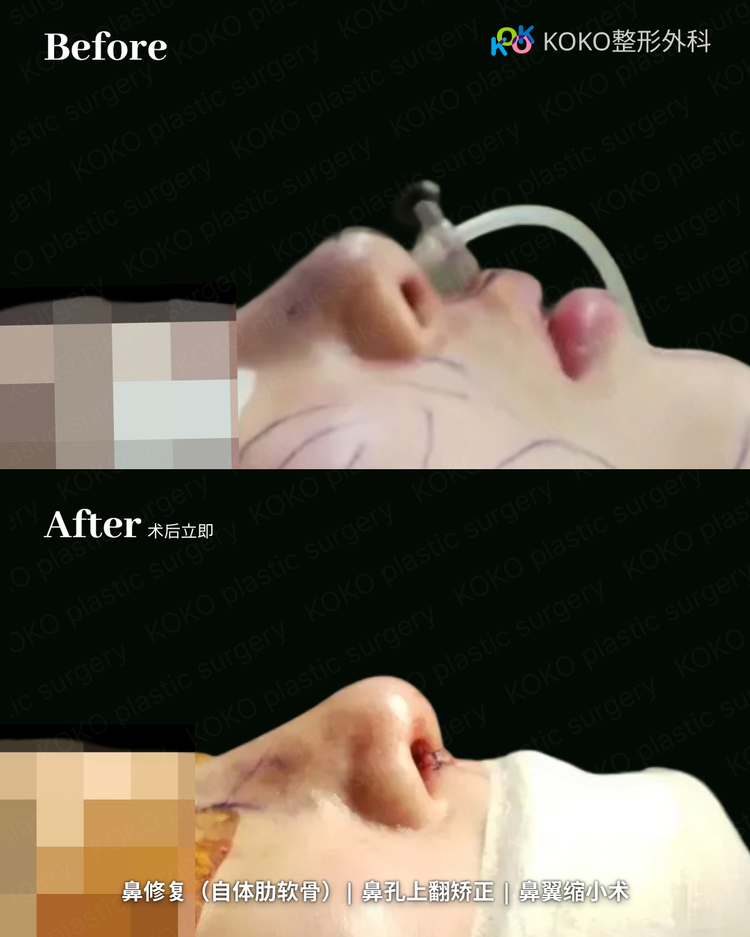 鼻修复手术对比图。上方“Before”照片显示患者躺在手术台上，鼻尖短缩且鼻孔上翻（朝天鼻）。下方“After”照片为术后立即拍摄，显示通过自体肋软骨修复后，鼻梁延长，鼻尖挺拔且下移，改善了鼻孔外露问题。