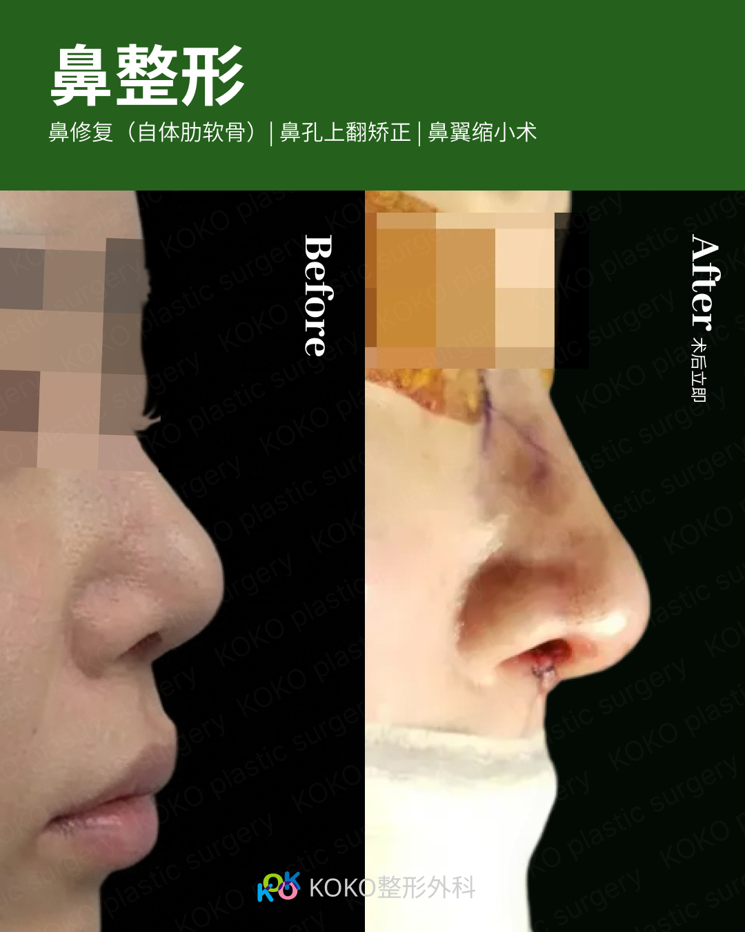 鼻整形手术前后的侧面对比。左侧“Before”显示鼻头圆钝且略微上翻。右侧“After”显示术后效果，通过自体肋软骨移植和鼻翼缩小术，鼻尖线条变得更加立体、精致，鼻唇角得到优化，整体轮廓更符合美学比例。