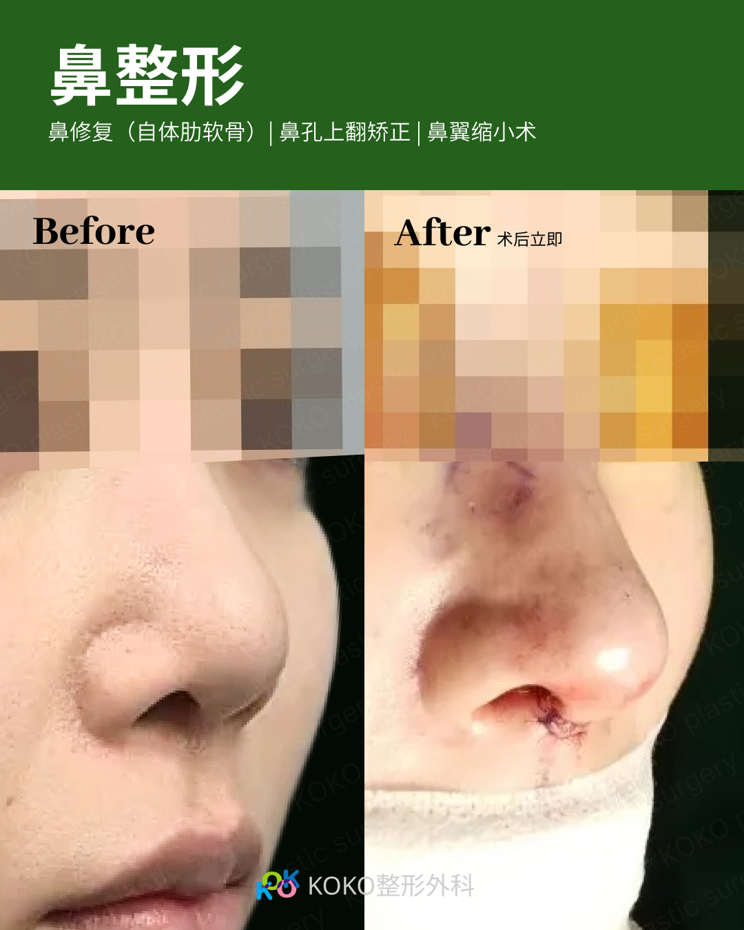 鼻部多项手术对比。左图“Before”显示鼻翼较宽，鼻孔上翻明显。右图“After”显示术后即刻状态，进行了鼻孔上翻矫正和鼻翼缩小。可以明显看到鼻翼变窄，鼻尖表现点更加清晰，伤口处有精细缝合，整体鼻型更加秀气。